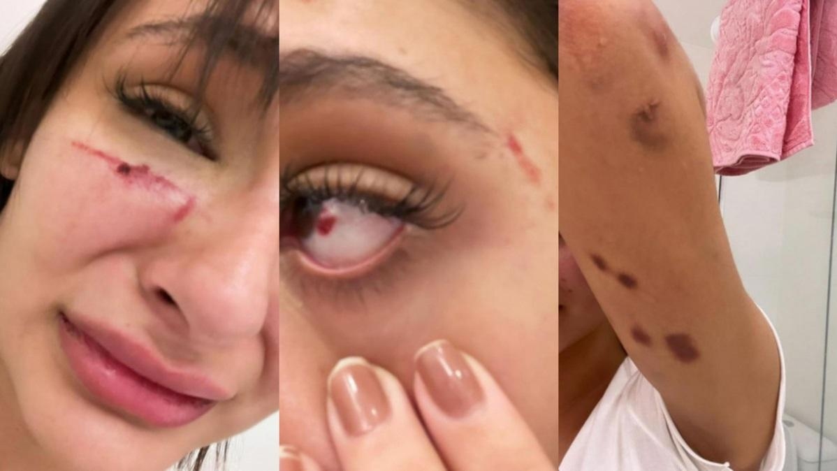Modelo Anna Figueiredo publica fotos machucada e denuncia agresses de ex-namorado - Zoeira - Dirio do Nordeste