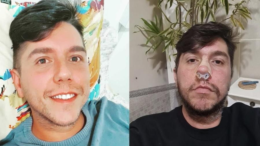Thiago Delgado de 35 anos fez preenchimento labial e perdeu parte do nariz - Arquivo pessoal