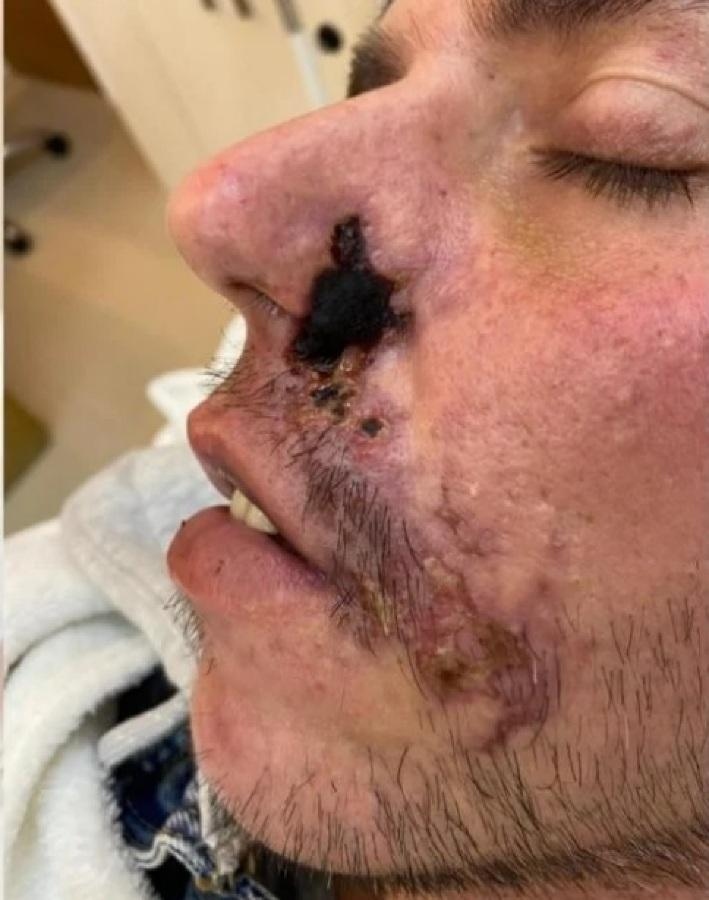Homem perde parte do nariz aps preenchimento labial malsucedido ReporterMT - Mato Grosso em um clique