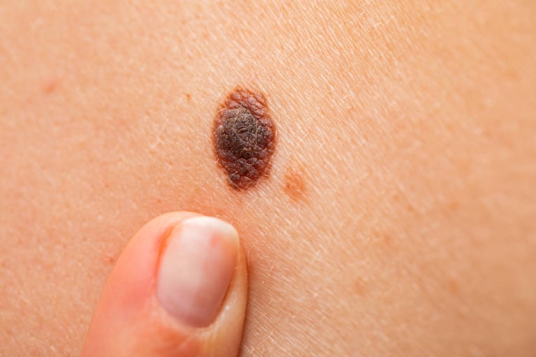 Novos estudos mostram eficcia da imunoterapia em combos e contra melanomas avanados - 04122020 - Seminrios Folha - Folha