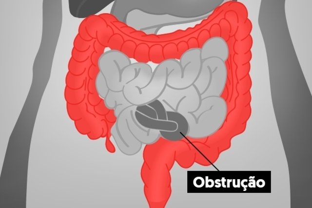 Obstruo intestinal o que sintomas causas e tratamento