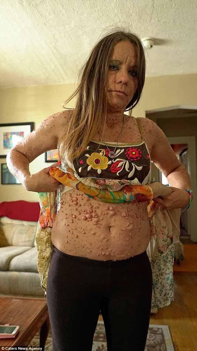 CURIOSIDADES Conhea a mulher tem quase seis mil tumores espalhados pelo corpo - ArapuaNews - Notcias de Trs Lagoas Mato Grosso do Sul Brasil e regio