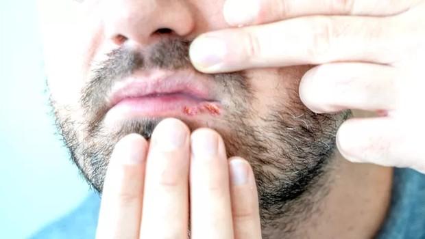 Herpes Foto GETTY IMAGES via BBC