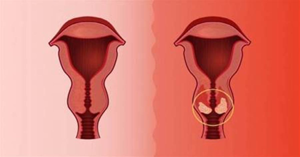 7 sinais de câncer de útero que se você ignorar pode ser tarde demais