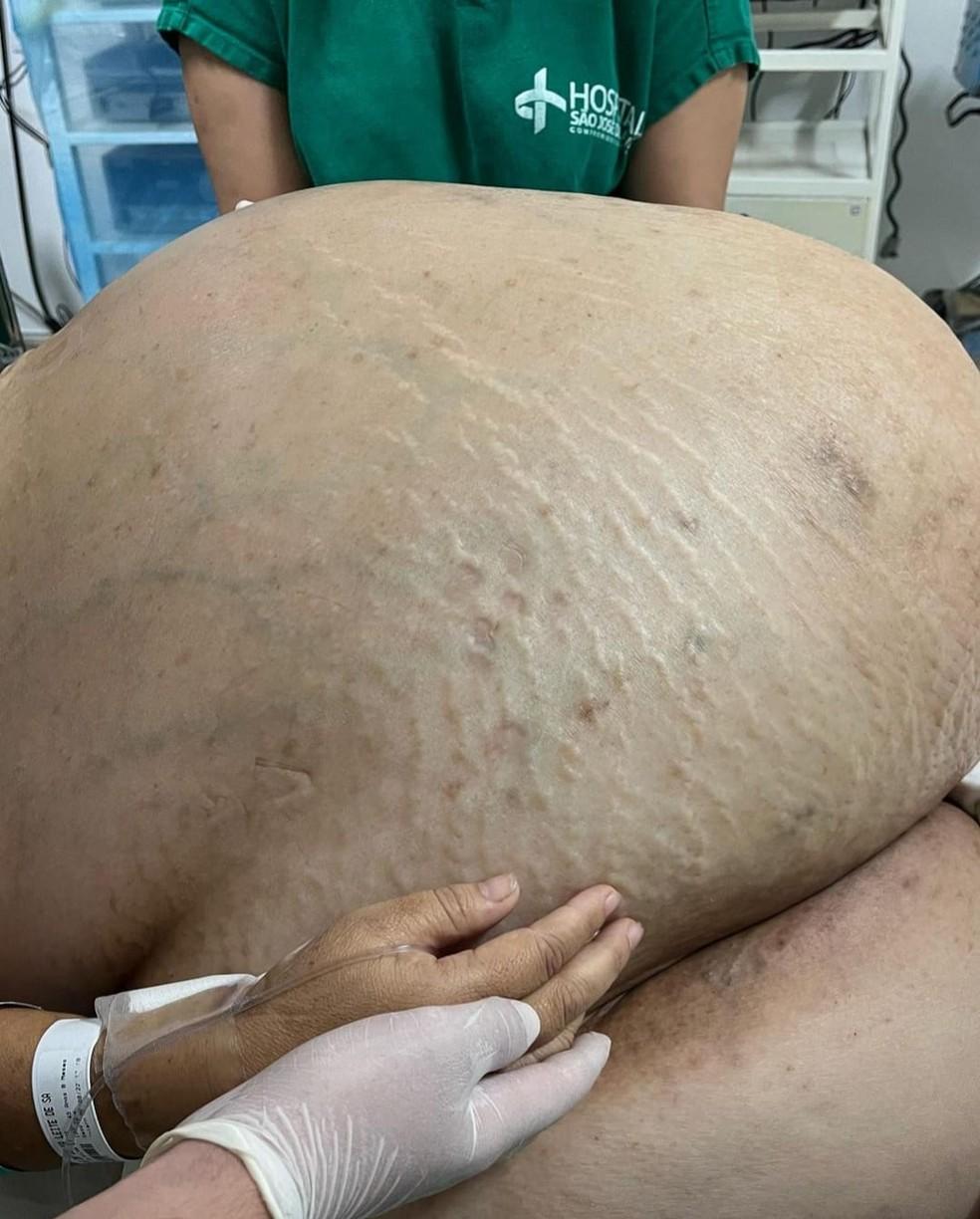 Paciente estava com o tumor h pelo menos 5 anos mulher natural de MG mas mora em Itaperuna Foto ReproduoInstagram