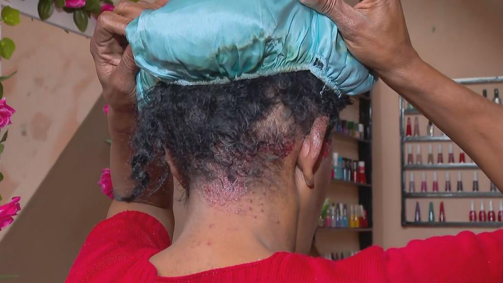 Alba Valria mostra a raiz dos cabelos com vermelhido e bolinhas aps tratamento capilar Foto Reproduo TV Globo